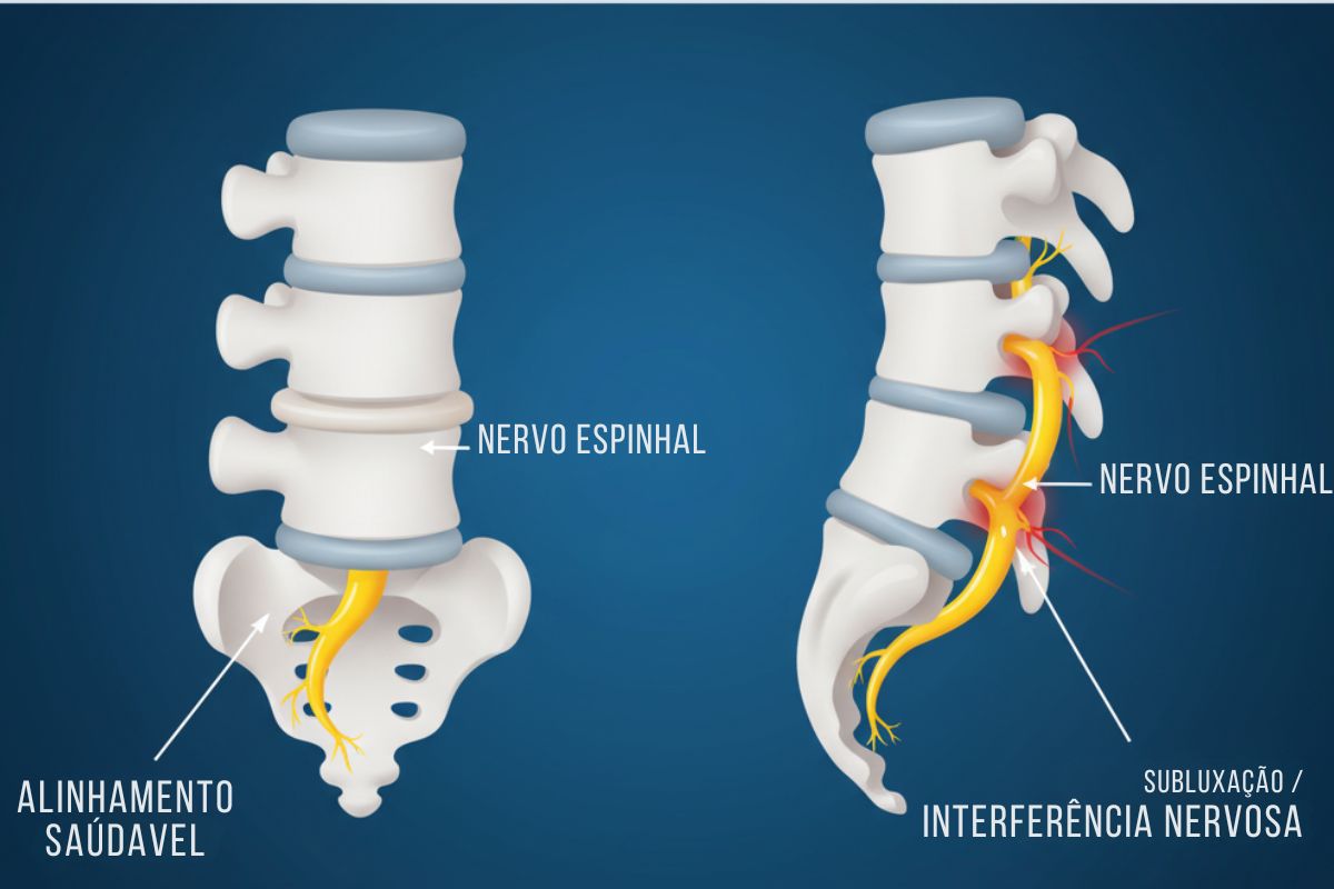 Tipos de Alterações Sensoriais Causadas pela Subluxação Vertebral Tipos de Alterações Sensoriais Causadas pela Subluxação Vertebral